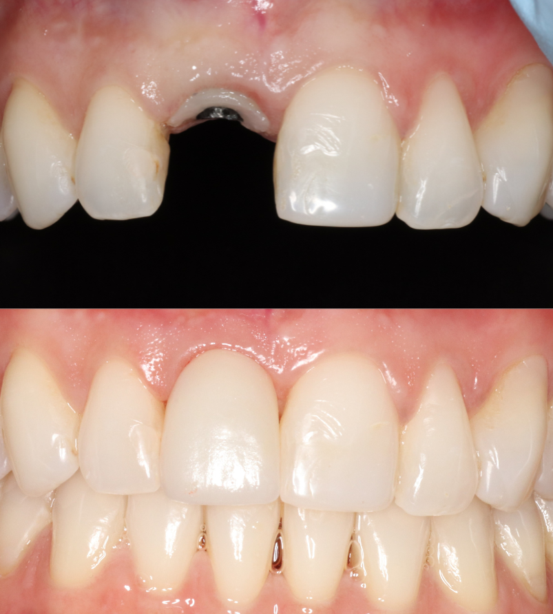 adv-implant-case-1