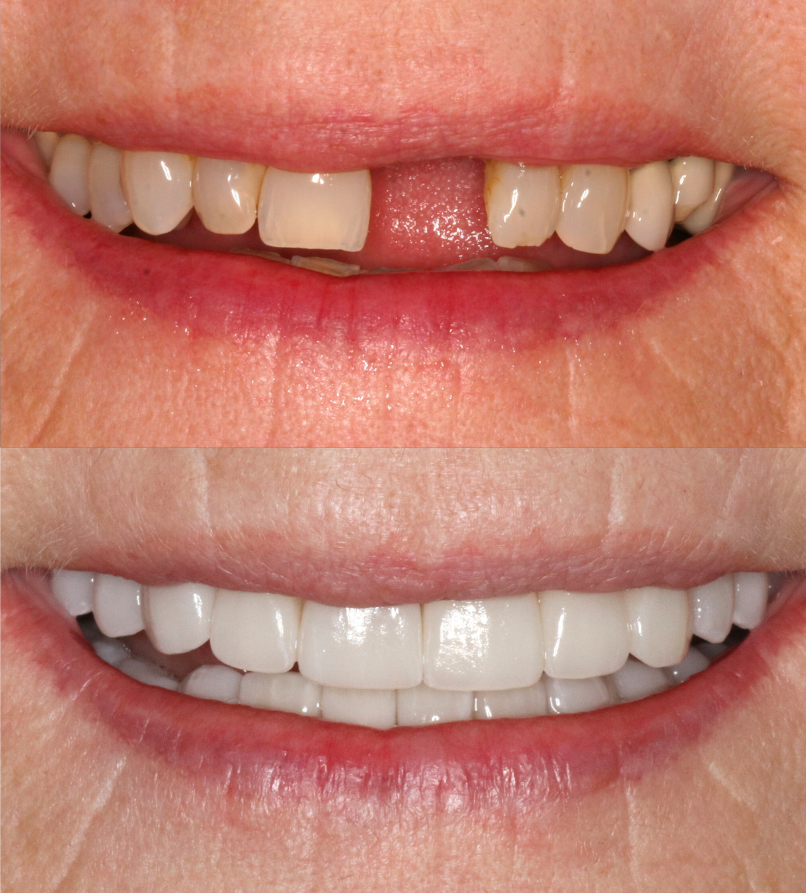 adv-implant-case-2