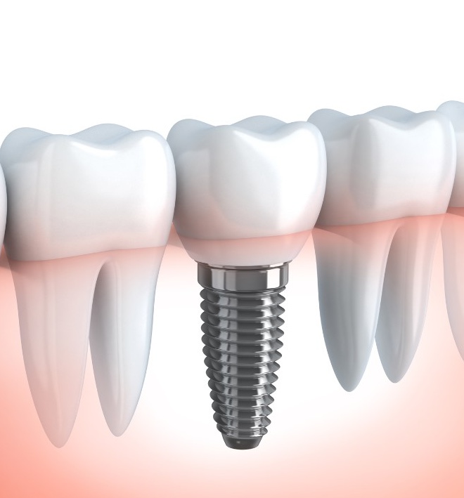 dental-implant